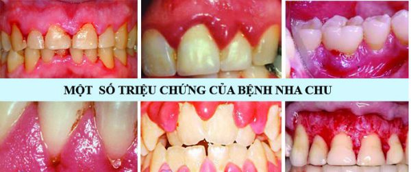 Biểu hiện của bệnh viêm nha chu