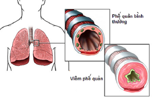 viem phe quan cap 1