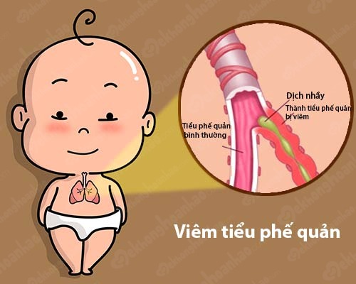 viem-tieu-phe-quan-o-tre-em