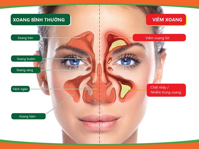 viem xoang 1 5