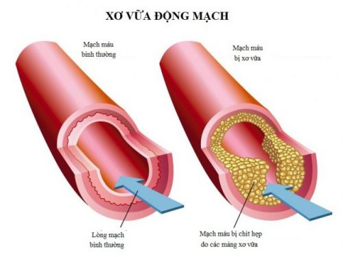 xo vua dong mach 1 e1546845169645 3