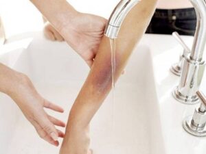 Xử lý vết bỏng bằng nước mát