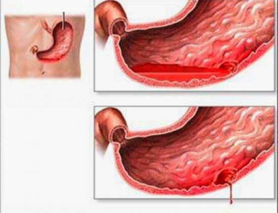 Sự nguy hiểm của bệnh xuất huyết dạ dày