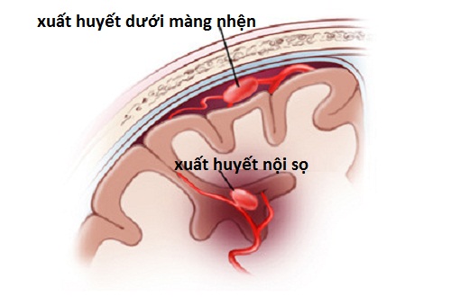 xuat-huyet-nao