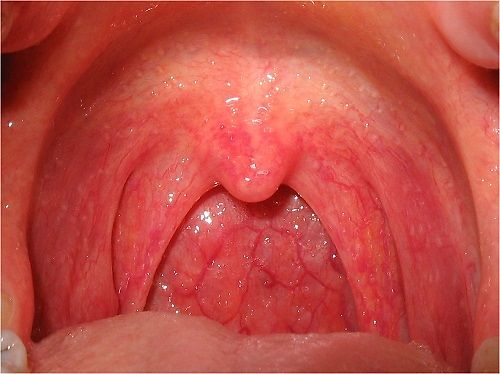 Biến chứng bệnh bạch hầu