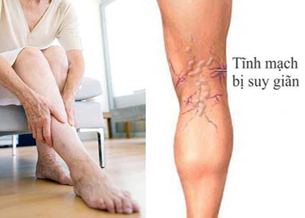 Bệnh suy giãn tĩnh mạch chân triệu chứng của được biểu hiện như nào ?