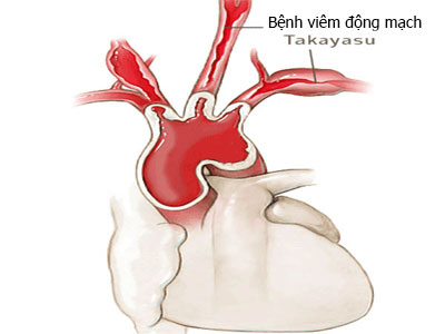 Viêm động mạch Takayasu là bệnh lý như thế nào?