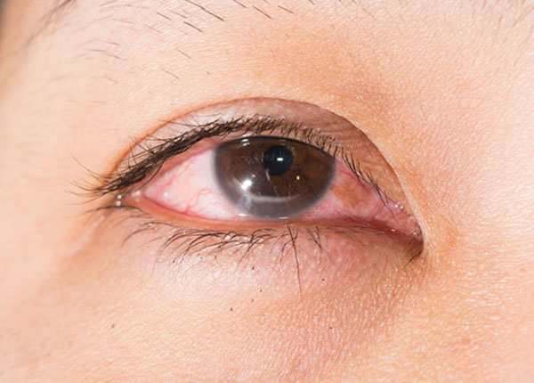 Cùng tìm hiểu nguyên nhân gây nên bệnh viêm giác mạc herpes