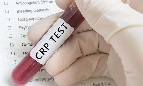 Chuyên gia cho biết ý nghĩa của xét nghiệm CRP là gì?
