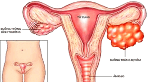 hinh anh viem phu khoa 2