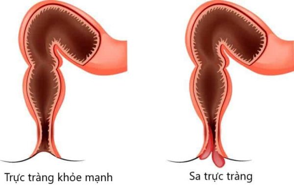 Tình trạng của chứng sa trực tràng