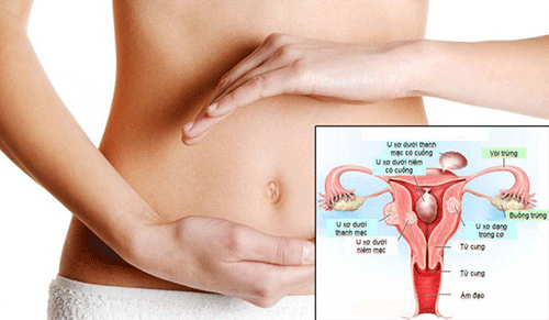 Tổng quan bệnh u xơ tử cung theo góc nhìn chuyên gia